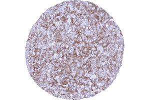 Hodgkins lymphoma containing a dense population of factor XIIIa positive cells (F13A1 抗体  (AA 46-181))