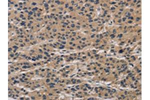 The image on the left is immunohistochemistry of paraffin-embedded Human liver cancer tissue using ABIN7190293(CLEC2A Antibody) at dilution 1/20, on the right is treated with synthetic peptide. (CLEC2A 抗体)
