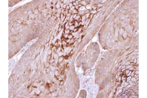IHC-P Image Immunohistochemical analysis of paraffin-embedded Cal27 xenograft, using KLK11, antibody at 1:100 dilution. (Kallikrein 11 抗体)