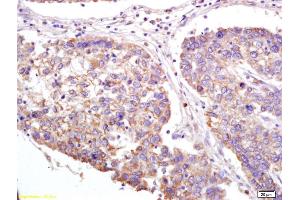 Formalin-fixed and paraffin embedded human lung carcinoma labeled with Anti-XAGE2 Polyclonal Antibody, Unconjugated (ABIN721750) at 1:200 followed by conjugation to the secondary antibody and DAB staining. (XAGE2 抗体  (AA 30-70))
