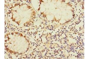 Immunohistochemistry of paraffin-embedded human colon cancer using ABIN7150754 at dilution of 1:100 (DUSP16 抗体  (AA 416-665))