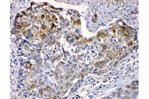 IHC testing of FFPE human esophageal squamous cancer with Cytokeratin 14 antibody at 1ug/ml.