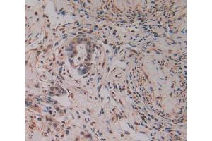IHC-P analysis of pancreas cancer tissue, with DAB staining.