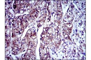 Immunohistochemical analysis of paraffin-embedded kidney cancer tissues using DCX mouse mAb with DAB staining.