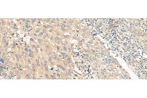 Immunohistochemistry of paraffin-embedded Human cervical cancer tissue using CHP1 Polyclonal Antibody at dilution of 1:25(x200) (CHP 抗体)