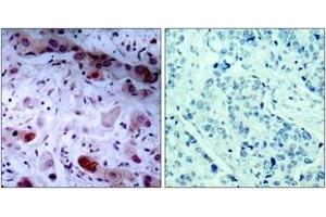 Immunohistochemistry analysis of paraffin-embedded human breast carcinoma, using JAK1 (Phospho-Tyr1022) Antibody. (JAK1 抗体  (pTyr1022))
