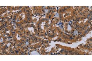 Immunohistochemistry of paraffin-embedded Human thyroid cancer tissue using NPTX1 Polyclonal Antibody at dilution 1:50 (NPX1 抗体)