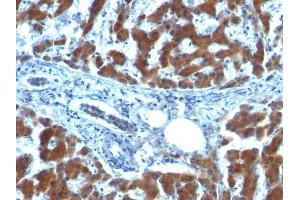 Formalin-fixed, paraffin-embedded human Hepatocellular Carcinoma stained with RBP1 (RBP/872) (RBP1 抗体)