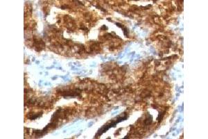 IHC testing of human prostate carcinoma with TAG-72 antibody (CA72/733). (TAG-72 抗体)