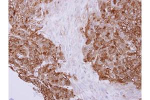 IHC-P Image Profilin 2 antibody detects PFN2 protein at cytoplasm on human colon carcinoma by immunohistochemical analysis. (PFN2 抗体)