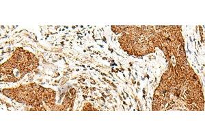 Immunohistochemistry of paraffin-embedded Human esophagus cancer tissue using SMOC1 Polyclonal Antibody at dilution of 1:50(x200) (SMOC1 抗体)