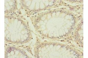 Immunohistochemistry of paraffin-embedded human colon cancer using ABIN7147204 at dilution of 1:100 (CD97 抗体  (AA 240-435))