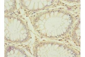 Immunohistochemistry of paraffin-embedded human colon cancer using ABIN7147204 at dilution of 1:100