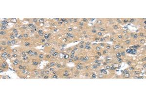 Immunohistochemistry of paraffin-embedded Human liver cancer tissue using TUSC2 Polyclonal Antibody at dilution 1:50