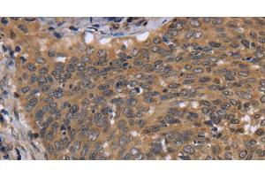 Immunohistochemistry of paraffin-embedded Human cervical cancer using FGFR1OP Polyclonal Antibody at dilution of 1:40 (FGFR1OP 抗体)