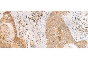 Immunohistochemistry of paraffin-embedded Human esophagus cancer tissue using PAX5 Polyclonal Antibody at dilution of 1:30(x200) (PAX5 抗体)