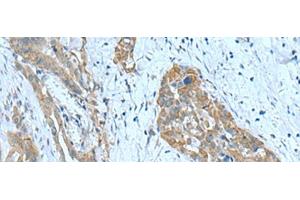 Immunohistochemistry of paraffin-embedded Human thyroid cancer tissue using SRPK2 Polyclonal Antibody at dilution of 1:90(x200) (SRPK2 抗体)