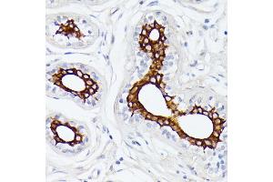Immunohistochemistry of paraffin-embedded human breast cancer using MT-ND5 antibody (ABIN7268603) at dilution of 1:100 (40x lens). (MT-ND5 抗体  (C-Term))