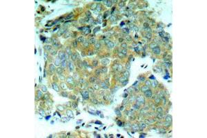 Immunohistochemistry of paraffin-embedded human breast carcinoma using Phospho-eIF2α-S51 antibody (ABIN2987989). (EIF2S1 抗体  (pSer51))