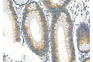 ABIN6258453 and ABIN6274980 at 1/100 staining Human colorectal cancer by IHC-P.