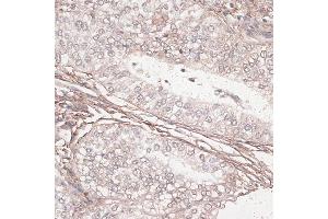 Immunohistochemistry of paraffin-embedded human uterine cancer using L antibody (ABIN7268186) at dilution of 1:100 (40x lens). (Laminin gamma 1 抗体  (AA 1300-1609))