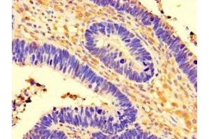 Immunohistochemistry of paraffin-embedded human ovarian cancer using ABIN7148172 at dilution of 1:100 (CCDC91 抗体  (AA 1-180))