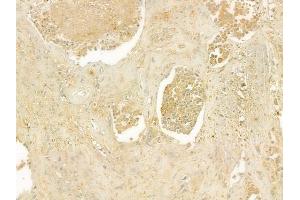 ABIN6262808 and ABIN6277591 at 1/100 staining human prostate carcinoma by IHC-P. (KIF2C 抗体  (C-Term))