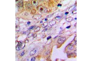 Immunohistochemical analysis of MP68 staining in human lung cancer formalin fixed paraffin embedded tissue section. (C14orf2 抗体  (Center))