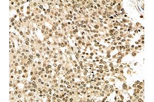 ABIN6262581 and ABIN6276765 at 1/100 staining Human ovarian cancer by IHC-P.