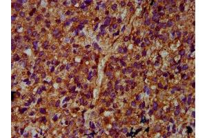 IHC image of ABIN7169209 diluted at 1:400 and staining in paraffin-embedded human glioma performed on a Leica BondTM system. (ULK2 抗体  (AA 211-276))