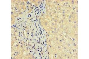 Immunohistochemistry of paraffin-embedded human liver cancer using ABIN7162135 at dilution of 1:100 (OBP2A 抗体  (AA 16-170))