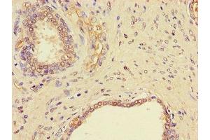 Immunohistochemistry of paraffin-embedded human prostate cancer using ABIN7145523 at dilution of 1:100 (Nerve Growth Factor 抗体  (AA 122-218))