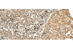 Immunohistochemistry of paraffin-embedded Human cervical cancer tissue using STT3A Polyclonal Antibody at dilution of 1:70(x200) (STT3A 抗体)