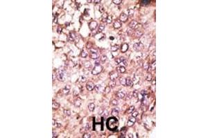 Formalin-fixed and paraffin-embedded human cancer tissue reacted with the primary antibody, which was peroxidase-conjugated to the secondary antibody, followed by AEC staining. (ATG4C 抗体  (AA 167-196))