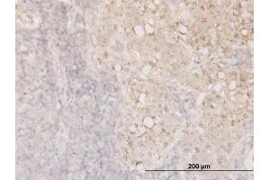 Immunoperoxidase of monoclonal antibody to CFL1 on formalin-fixed paraffin-embedded human breast cancer. (Cofilin 抗体  (AA 1-166))