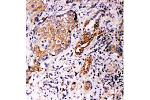 Anti-Annexin A10 antibody, IHC(P) IHC(P): Human Lung Cancer Tissue (Annexin a10 抗体  (C-Term))