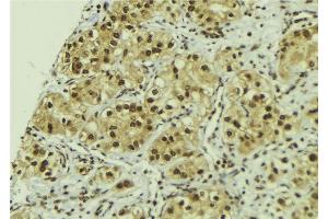 ABIN6267198 at 1/100 staining Human breast cancer tissue by IHC-P. (TLK1 抗体  (pSer743))