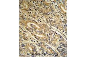 Formalin-fixed and paraffin-embedded human Prostate carcinoma reacted with ACOT8 Antibody (C-term), which was peroxidase-conjugated to the secondary antibody, followed by DAB staining. (ACOT8 抗体  (C-Term))
