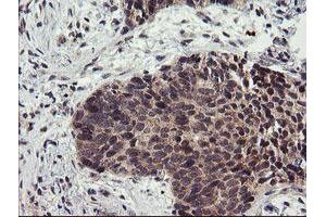Immunohistochemical staining of paraffin-embedded Carcinoma of Human lung tissue using anti-LRRC25 mouse monoclonal antibody. (LRRC25 抗体)