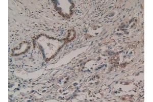 IHC-P analysis of Human Pancreas Cancer Tissue, with DAB staining. (EZH2 抗体  (AA 51-285))