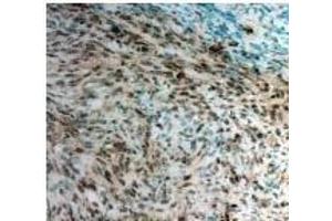 Twist1 Antibody staining Twist in Mouse pancreatic cancer tissue sections by Immunohistochemistry (TWIST1 抗体)