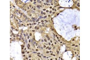 Immunohistochemistry of paraffin-embedded Human oophoroma using ARID3A Polyclonal Antibody at dilution of 1:100 (40x lens). (ARID3A 抗体)