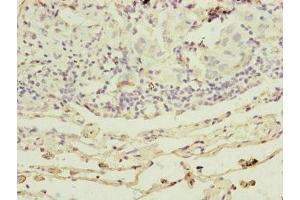 Immunohistochemistry of paraffin-embedded human lung cancer using ABIN7164324 at dilution of 1:100 (RARS2 抗体  (AA 17-340))