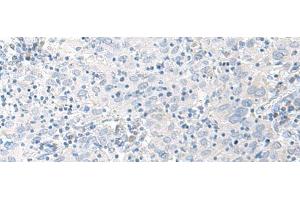 Immunohistochemistry of paraffin-embedded Human cervical cancer tissue using STAU2 Polyclonal Antibody at dilution of 1:45(x200) (Double-stranded RNA-binding protein Staufen homolog 2 (STAU2) 抗体)