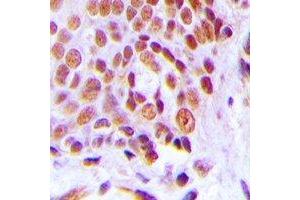 Immunohistochemical analysis of C/EBP gamma staining in human breast cancer formalin fixed paraffin embedded tissue section. (CEBPG 抗体)