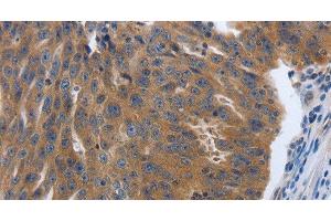 Immunohistochemistry of paraffin-embedded Human ovarian cancer tissue using PDGFA Polyclonal Antibody at dilution 1:70 (PDGFA 抗体)