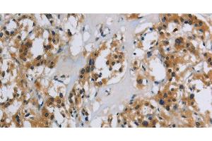 Immunohistochemistry of paraffin-embedded Human thyroid cancer using SYN1 Polyclonal Antibody at dilution of 1:40 (SYN1 抗体)