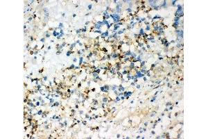 IHC-P: CD63 antibody testing of human intestinal cancer tissue (CD63 抗体  (AA 97-238))