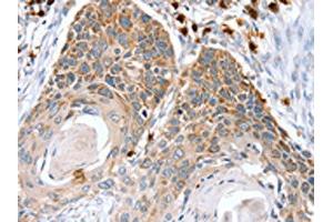 The image on the left is immunohistochemistry of paraffin-embedded Human esophagus cancer tissue using ABIN7130898(RNF185 Antibody) at dilution 1/20, on the right is treated with fusion protein. (RNF185 抗体)