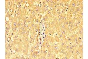 Immunohistochemistry of paraffin-embedded human liver cancer using ABIN7149746 at dilution of 1:100 (DSE 抗体  (AA 23-270))